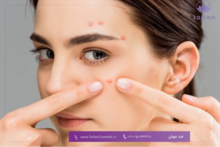 جوش روی صورت یک خانم