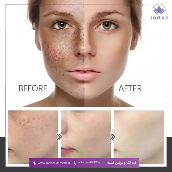 تصویر قبل و بعد روشن تر شدن پوست یک خانم و روند روشن شدن آن بعد از استفاده از ضد لک و روشن کننده