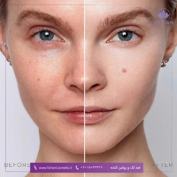 تصویر قبل و بعد صورت یک خانم که بعد از استفاده از ضد لک و روشن کننده نسبت به قبل پوست آن روشن تر شده است