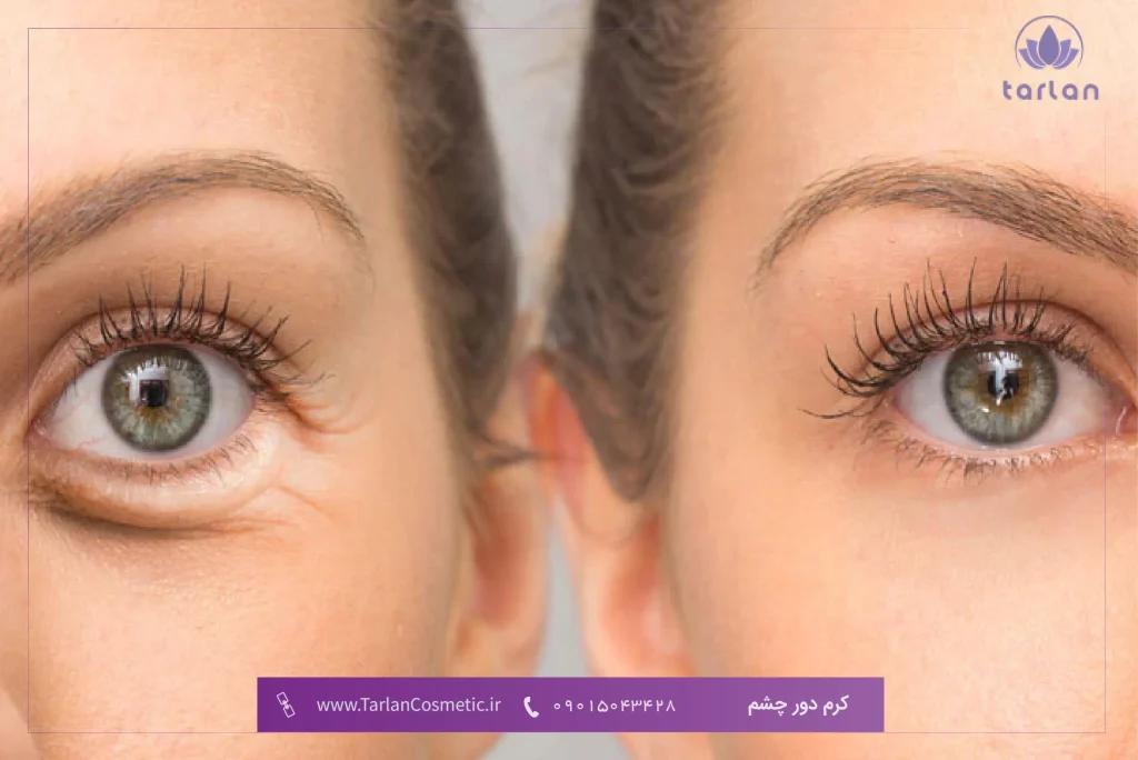 تصویر قبل و بعد از چشم یک خانم که پف زیر چشم داشته است و بعد از استفاده از کرم دور چشم بهبود یافته است