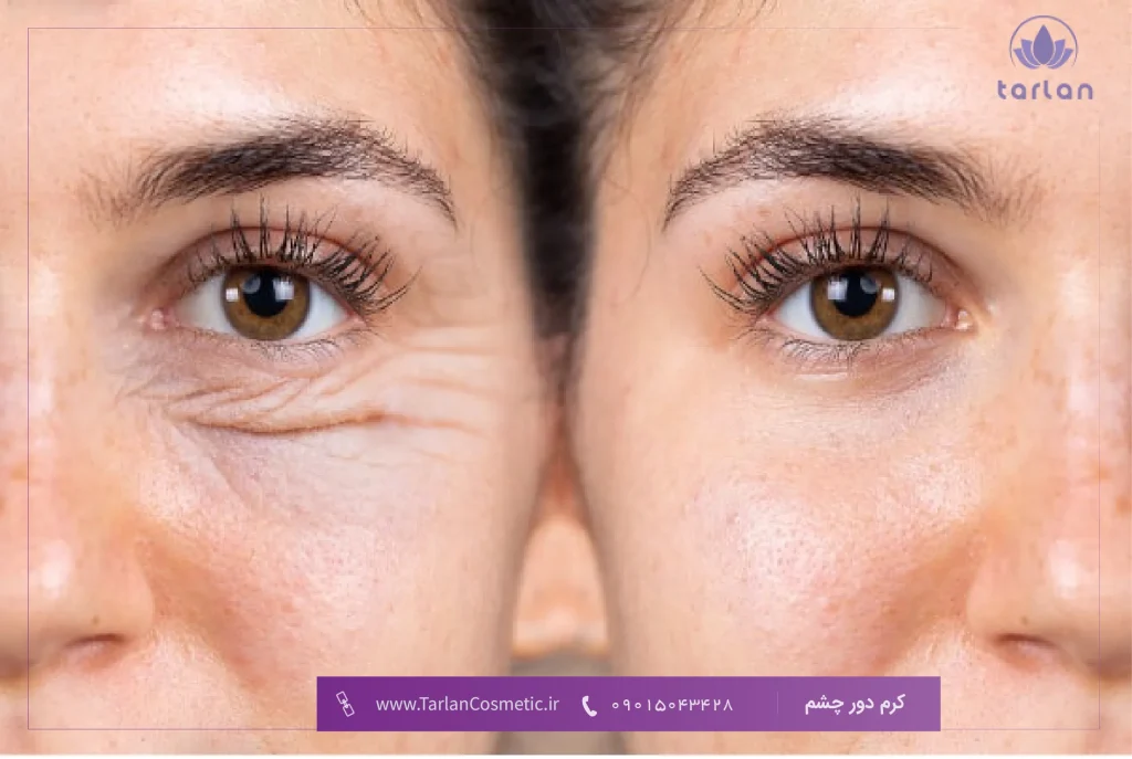تصویر قبل و بعد از چشم یک خانم که چروک زیر چشم داشته و بعد از استفاده از کرم دور چشم بهبود یافته است