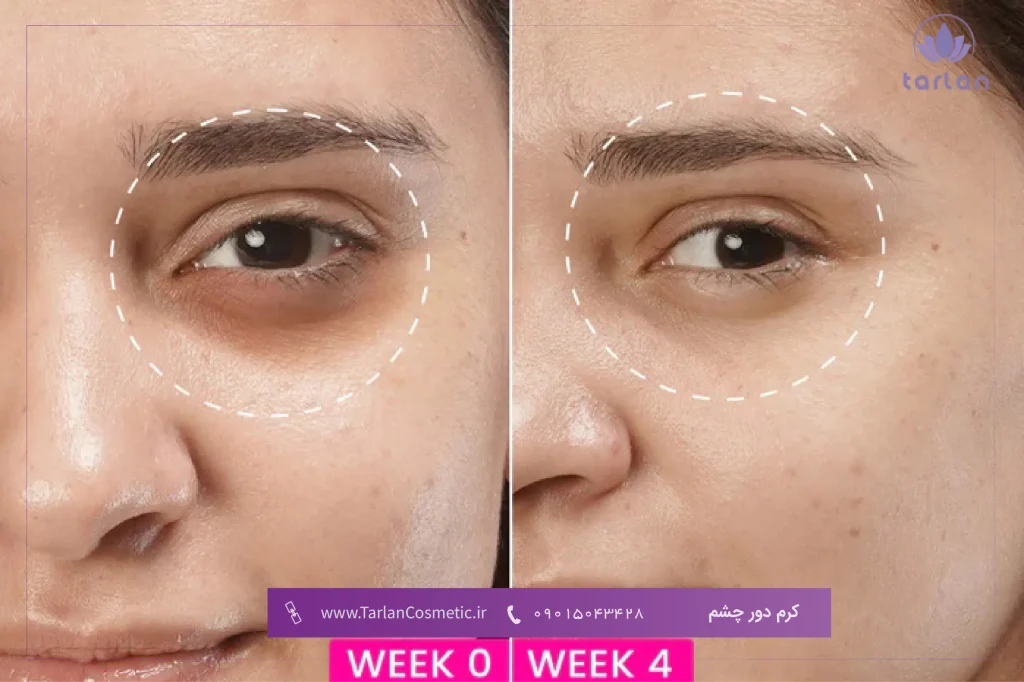تصویر قبل و بعد از چشم یک خانم که سیاهی زیر چشم داشته و بعد از استفاده از کرم دور چشم بهبود یافته است