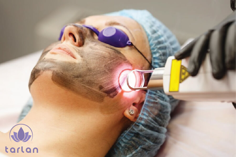 لایه برداری شیمیایی پوست صورت یک خانم به وسیله دستگاه توسط متخصص