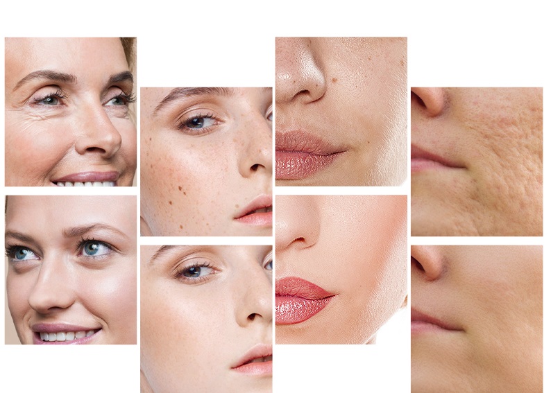 8 تصویر از صورت خانم های مختلف قبل و بعد از لایه برداری پوست صورت